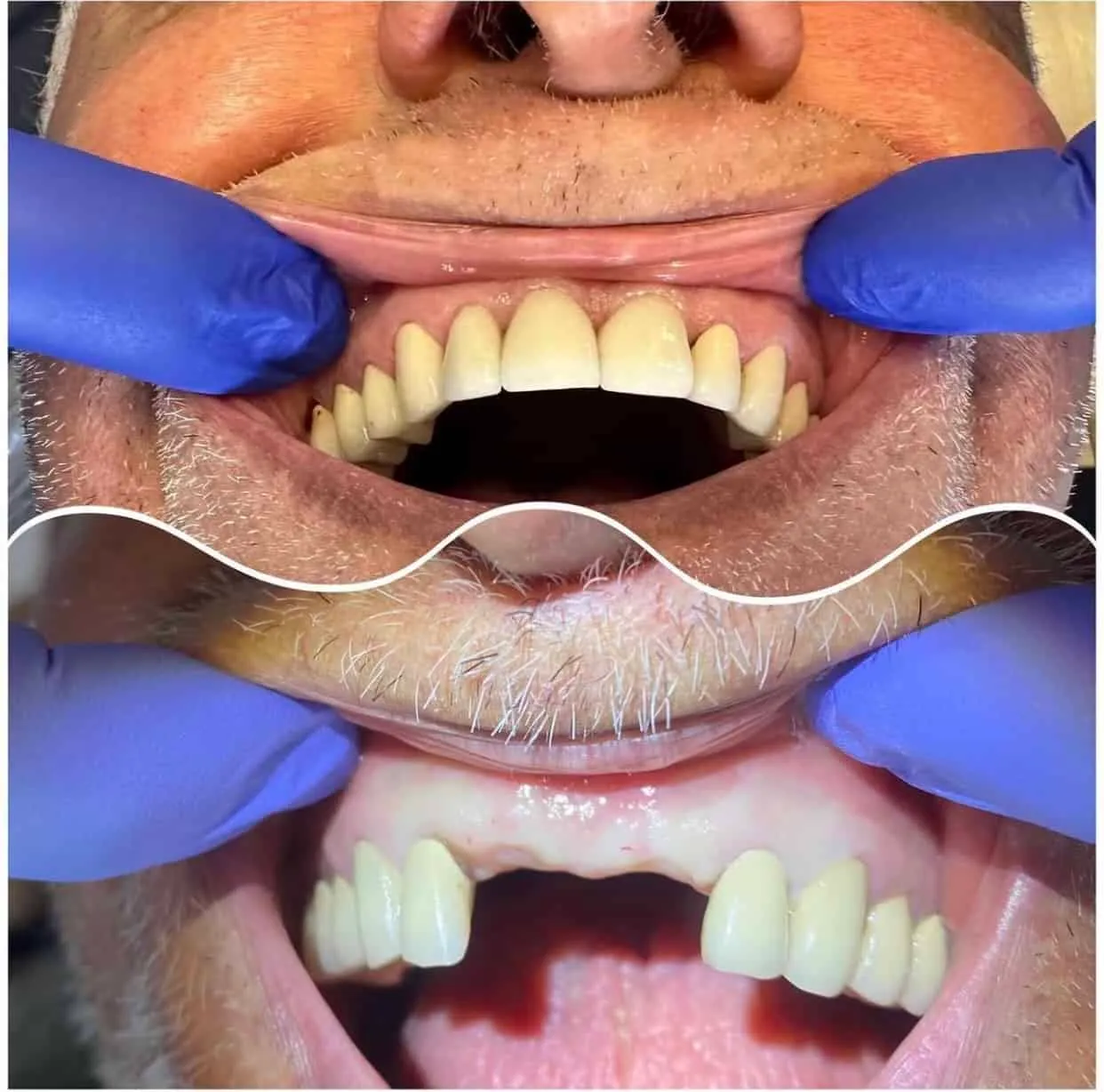 Before-and-after dental implant restoration of the upper front teeth