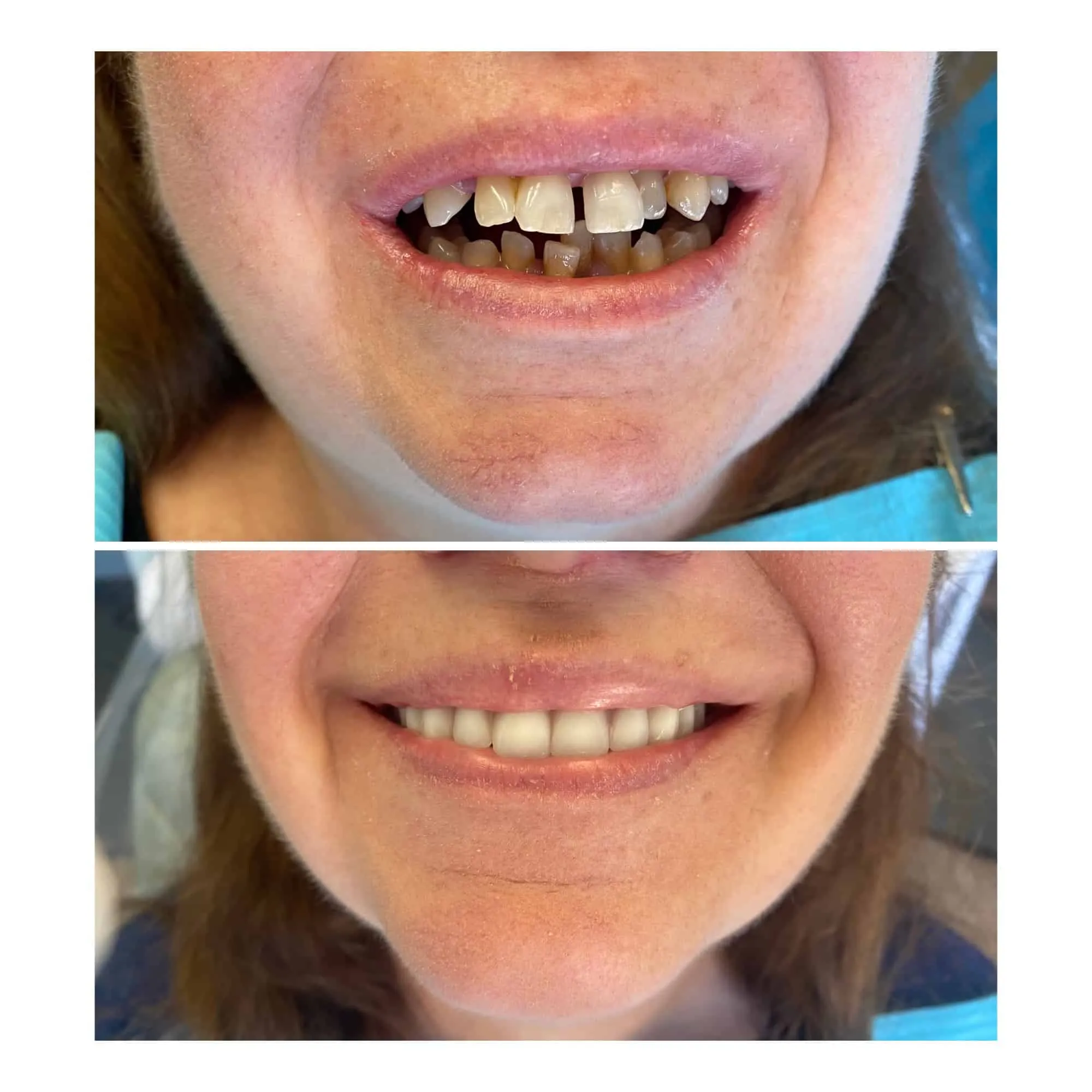 Before-and-after dental implant smile transformation