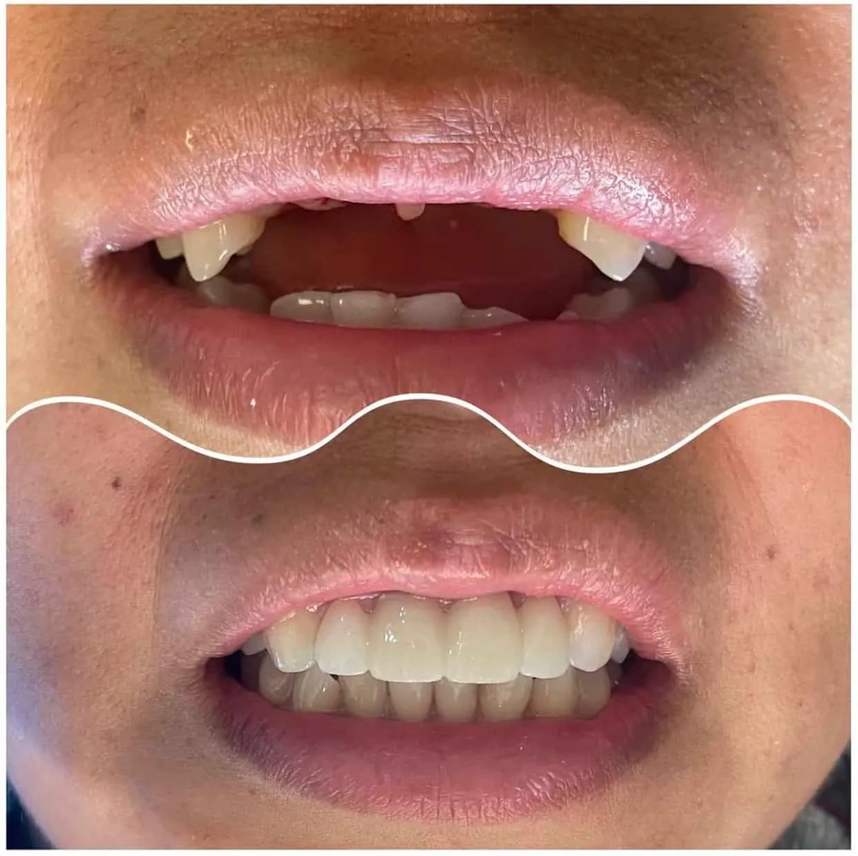 Before-and-after full-smile dental implant result