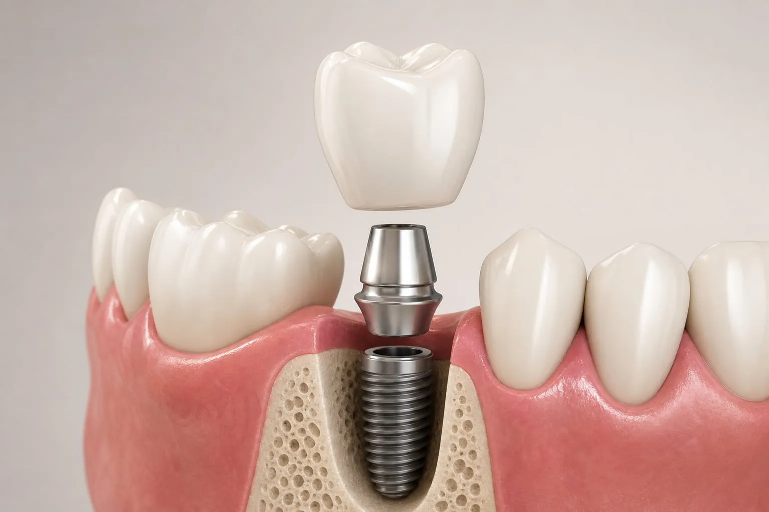 A 3D illustration of a single dental implant crown